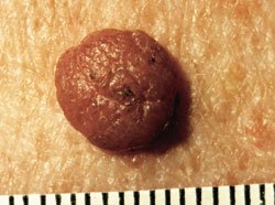 Что такое меланома: определение, методы лечения