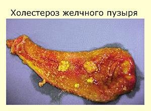 Холестероз-образование холестериновых бляшек