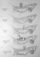 Стерилизующие операции на маточных трубах Стерилизующие операции на маточных трубах