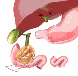 Хронический панкреатит