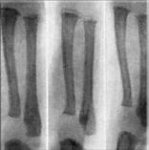 Рахит у детей: симптомы и лечение