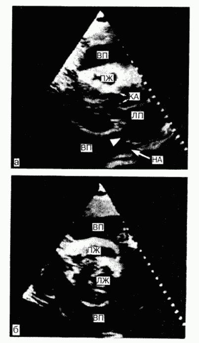  Эхокардиография: Диагностика перикардиального выпота