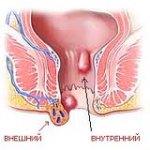 Геморрой: что такое и способы борьбы с геморроем