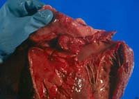 Эндокардиты различной этиологии